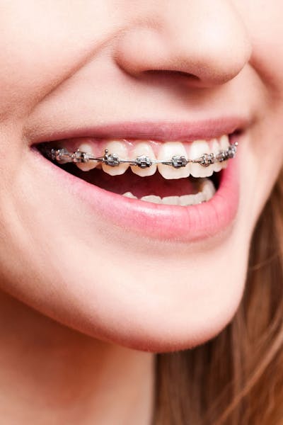 Traditional Braces