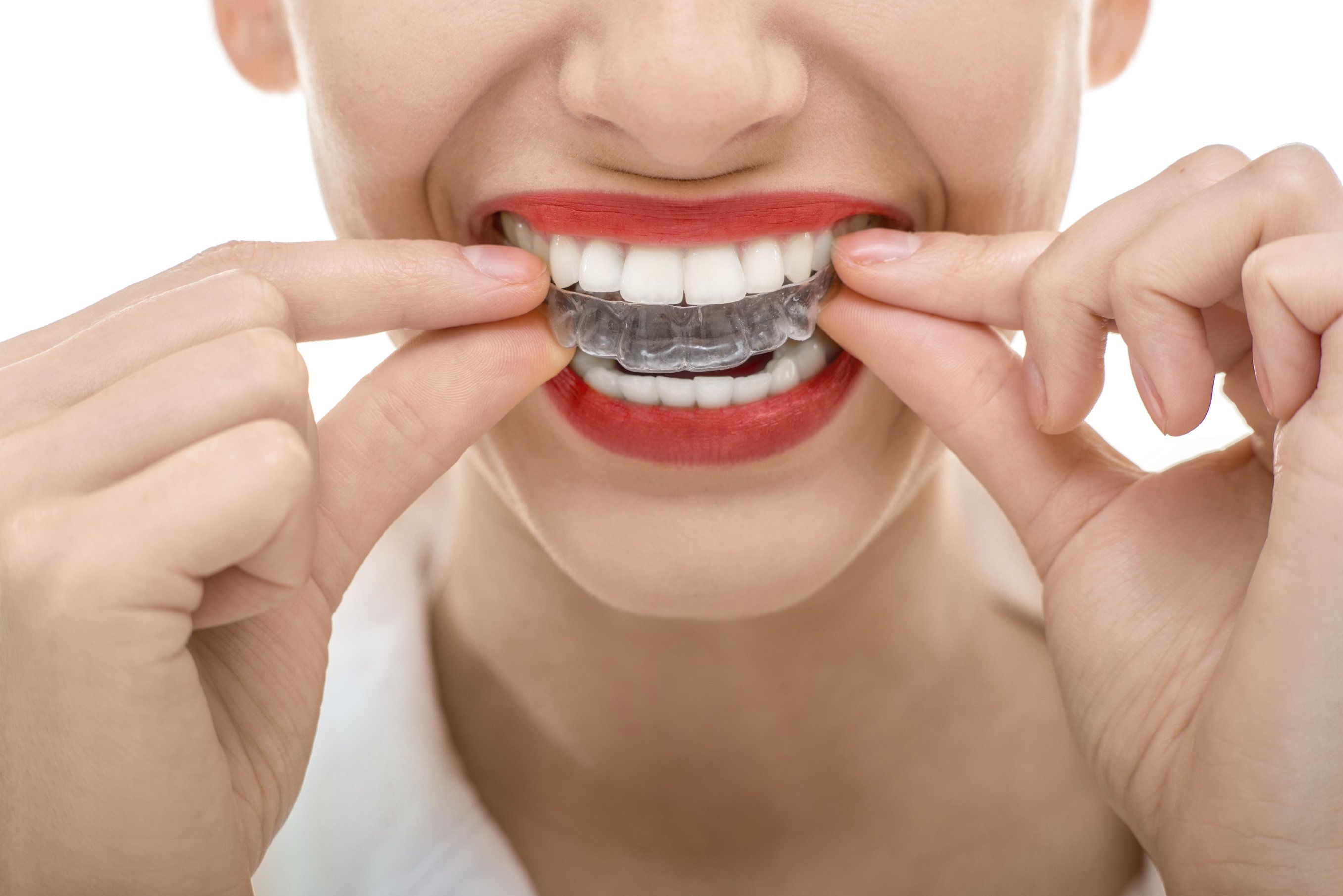 Invisalign vs braces (which treatment is better for my needs?)