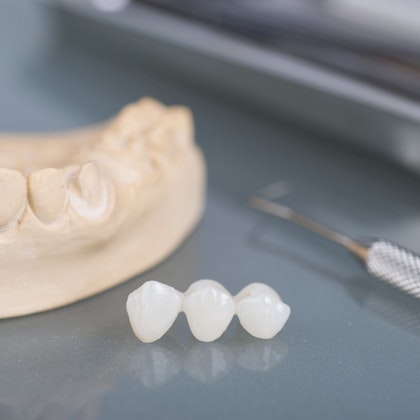 dental bridge on table with jaw mold