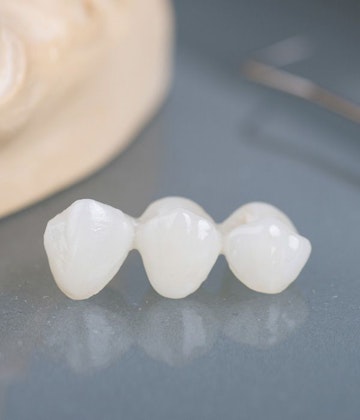 A porcelain dental bridge