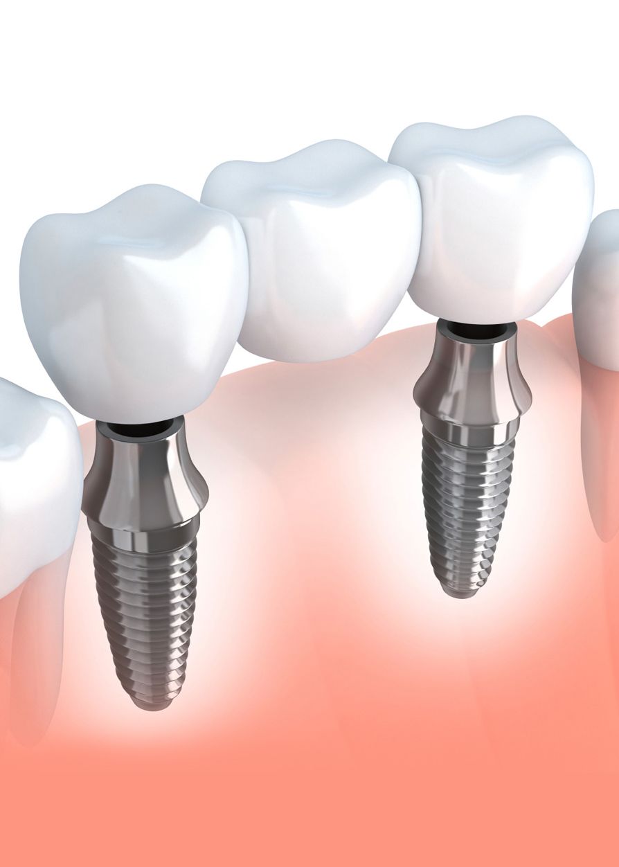 Illustration of an implant-supported dental bridge