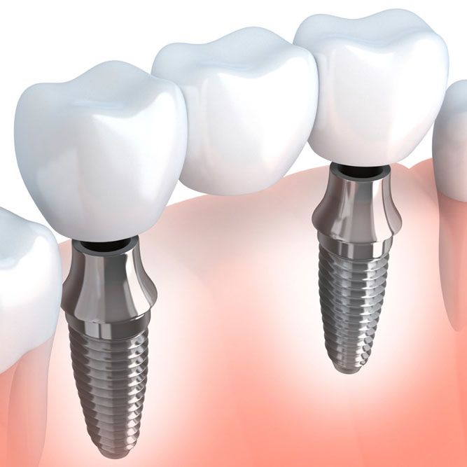 Digital illustration showing the components of an implant-supported bridge