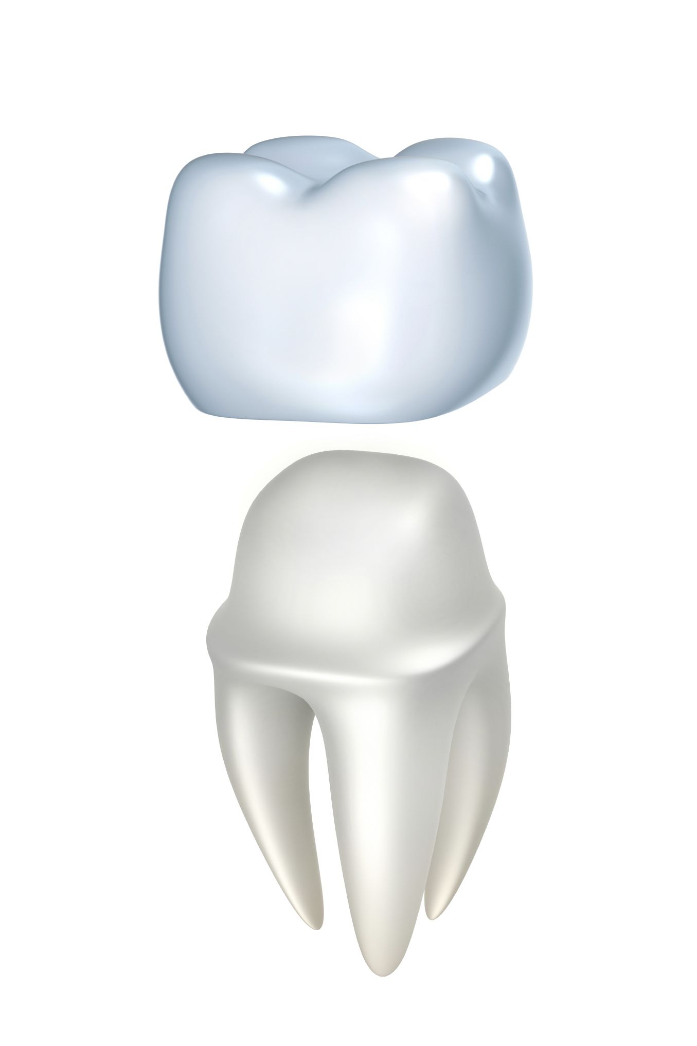 Illustration of a Dental crown