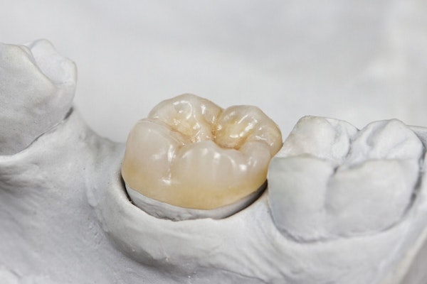 Crown on model of tooth