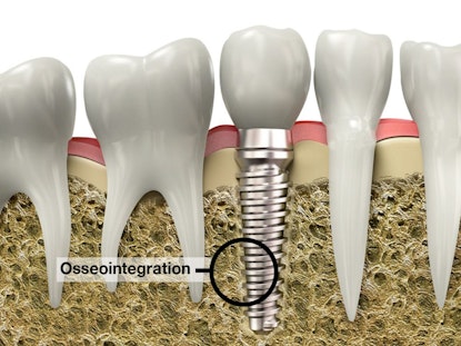 Illustration demonstrating osseointegration