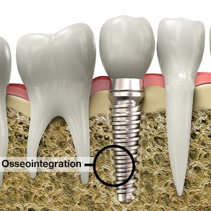Illustration demonstrating osseointegration