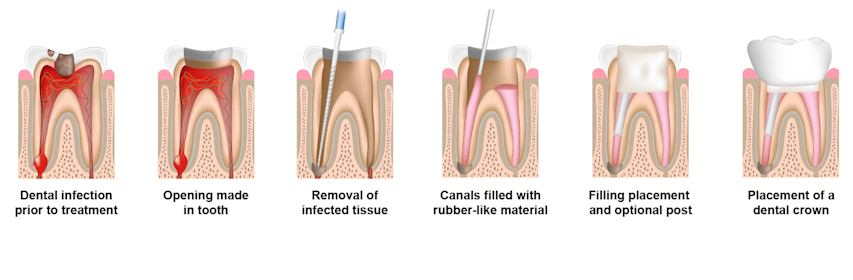 Road to Restoration: Dealing with Scar Tissue after Root Canal