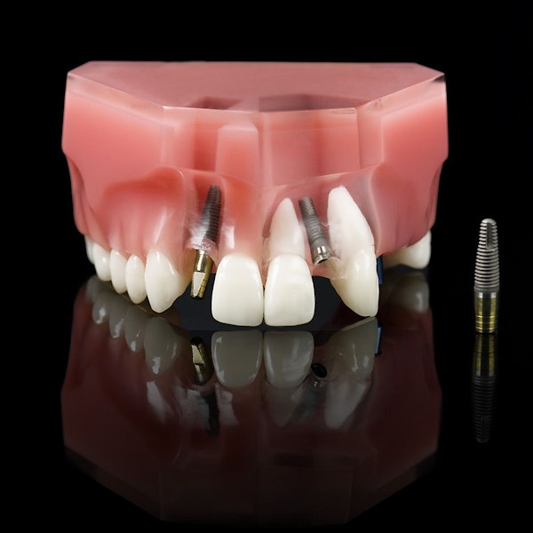 Model of jaw with implants