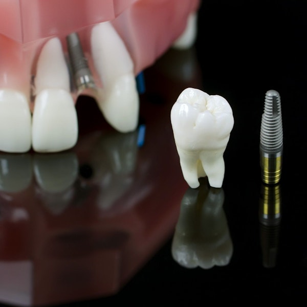 Implants and crowns