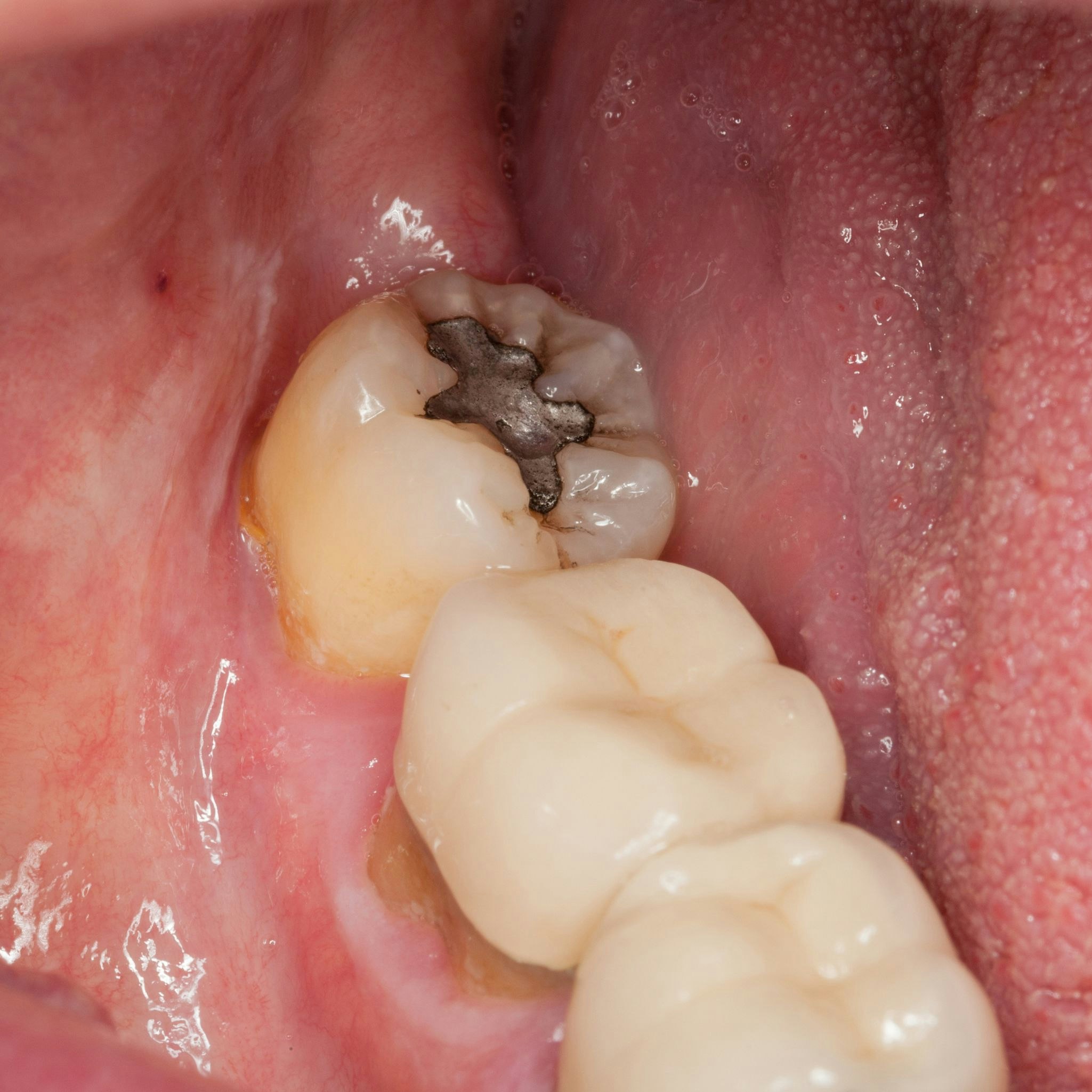 molar with decay on crown