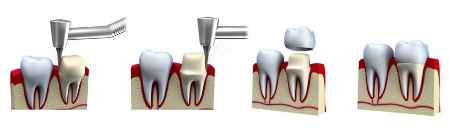 The porcelain crown treatment process.