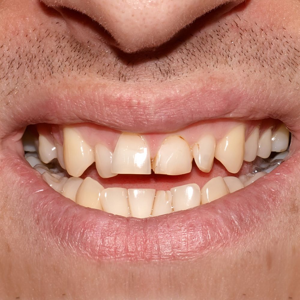 Chipped teeth