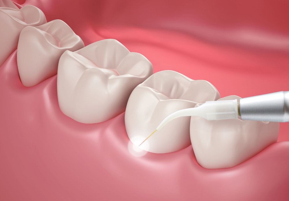 Laser dentistry being performed on teeth and gums.