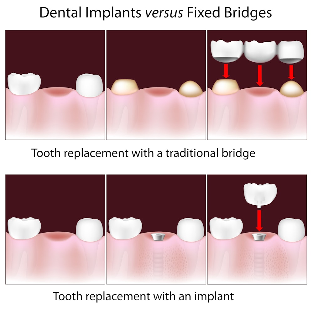 image of traditional bridge versus dental implants