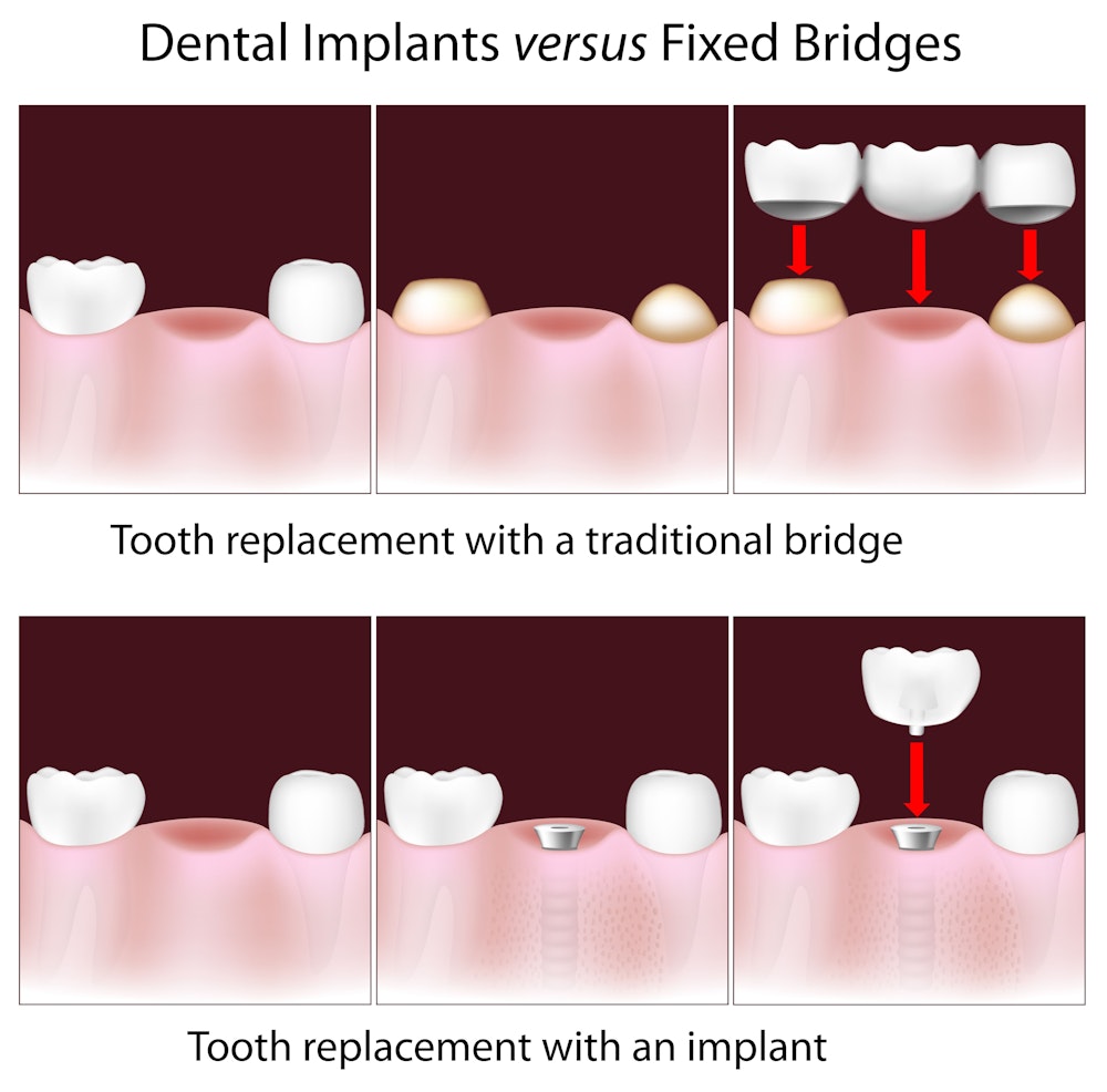 image of traditional bridge versus dental implants