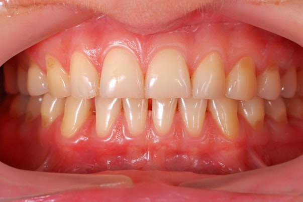 image of smile after laser gum reshaping