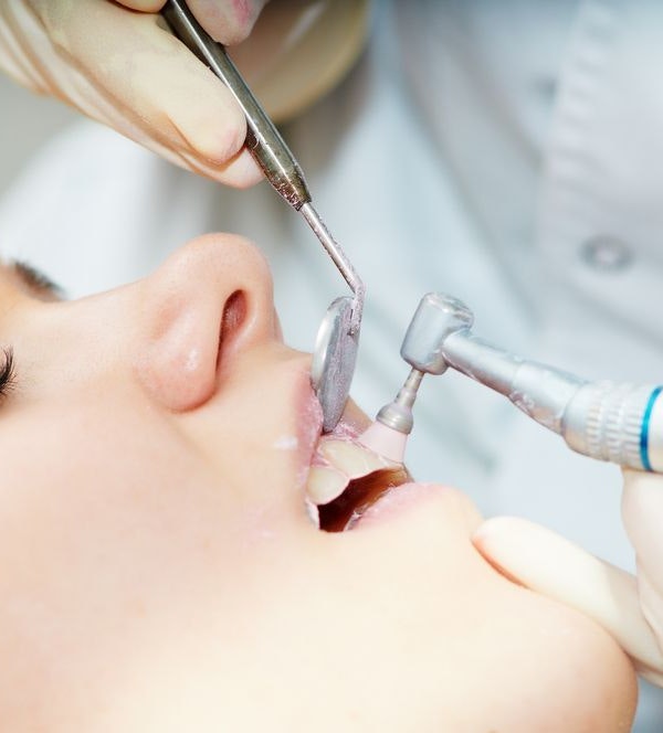 preparing teeth for veneers