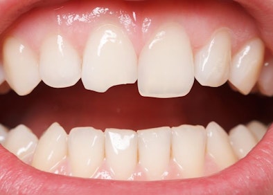 Image of chipped front tooth