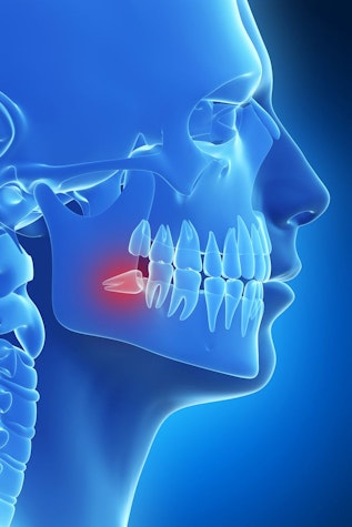 image of wisdom tooth pain