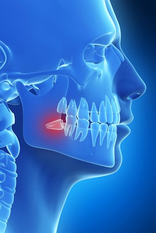 Wisdom Teeth Removal Henderson, NV - Carepoint Dental