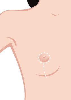  lollipop mastopexy diagram