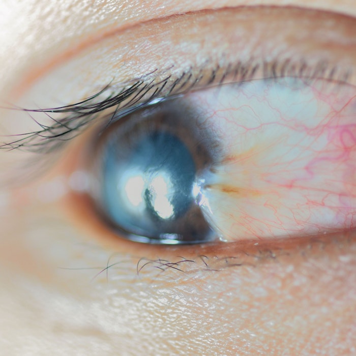 Close-up of a pterygium