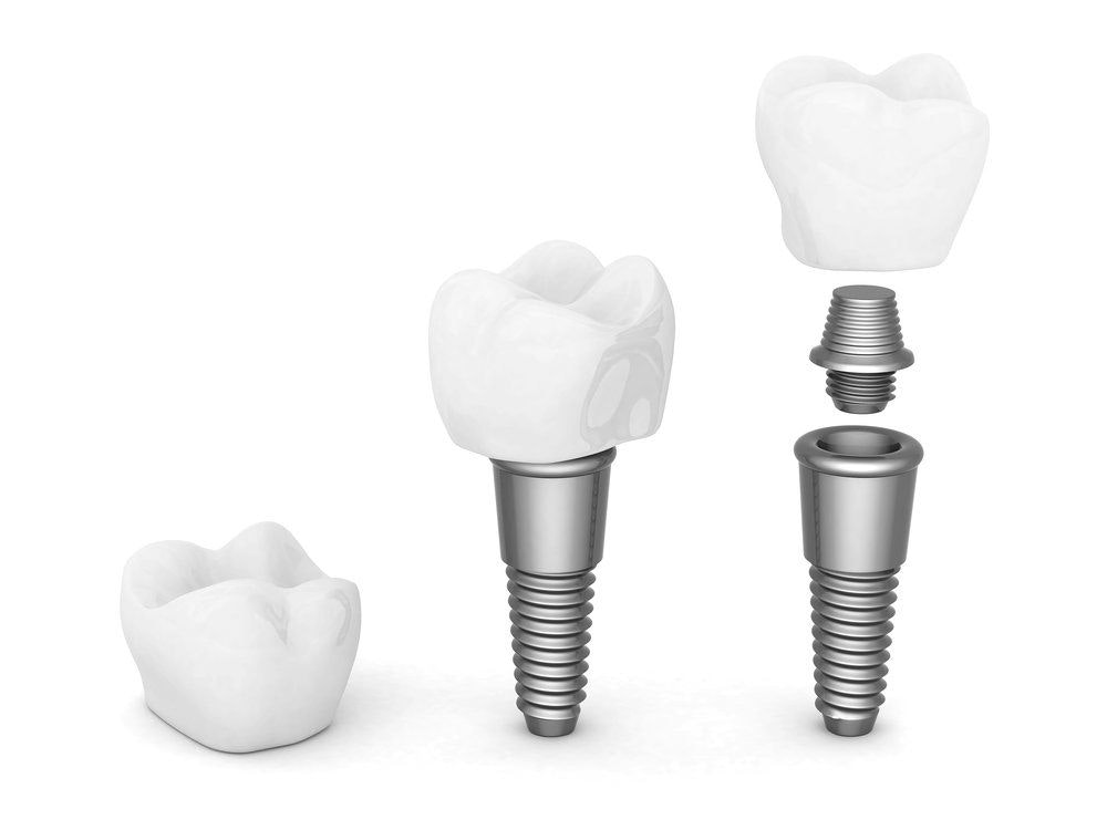 Stages of dental implant construction