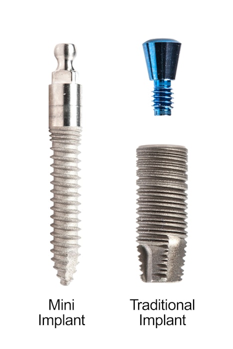Mini and traditional dental implants