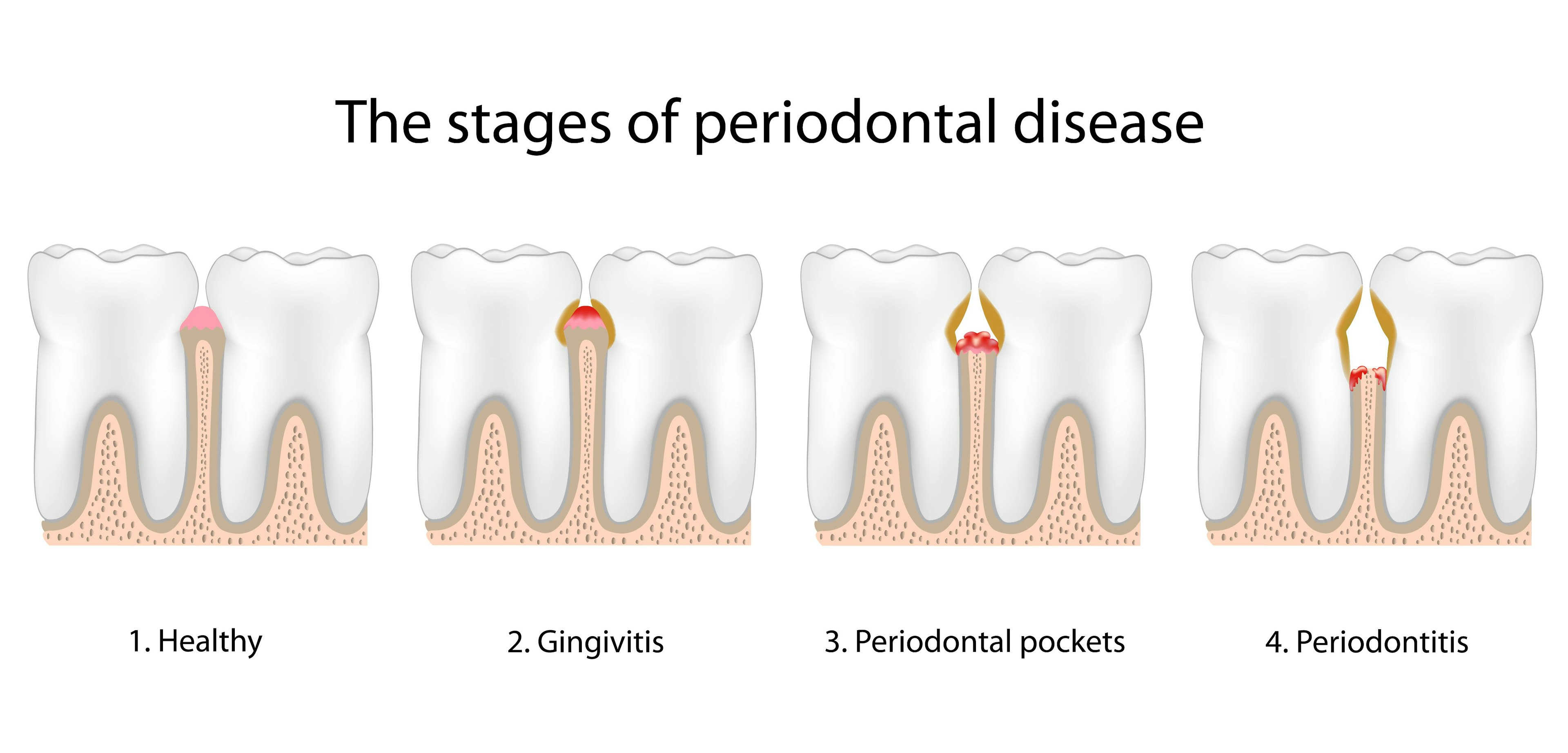 Image of normal tooth and tooth with periodontal disease