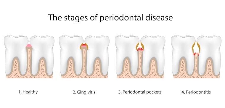 illustration of gum disease