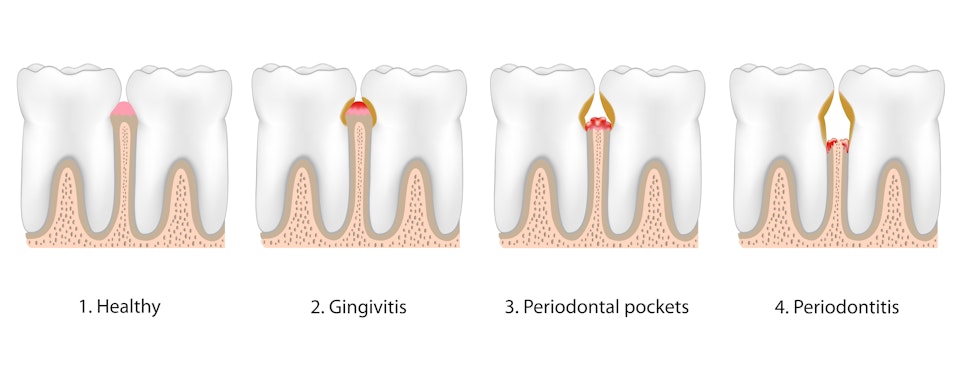 Stages of periodontal disease