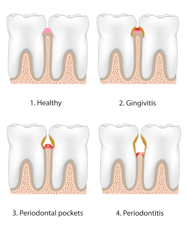 Illustration showing stages of gum disease
