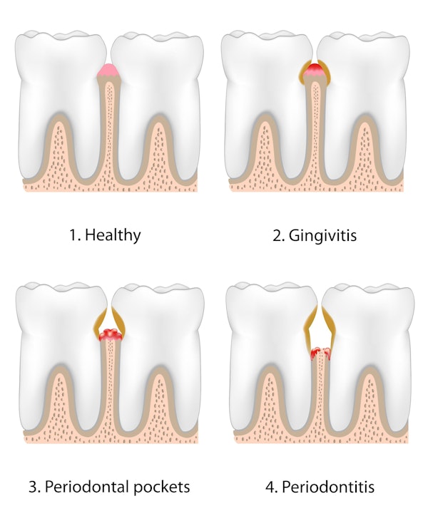 Illustration showing stages of gum disease