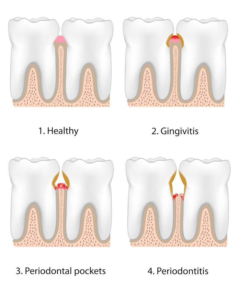 Illustration demonstrating progression of periodontal disease and decay.
