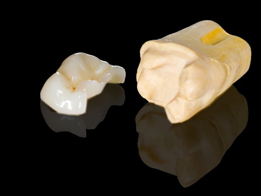 Inlay and model of tooth