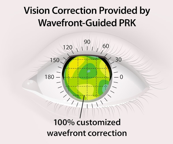 Diagram of Wavefront-guided PRK