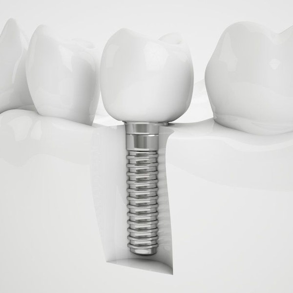 Dental Implant