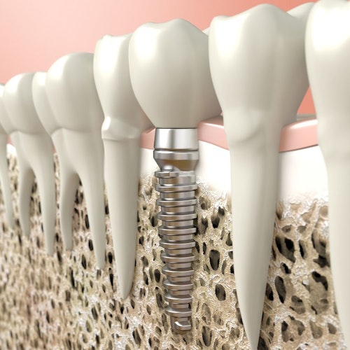 dental implant
