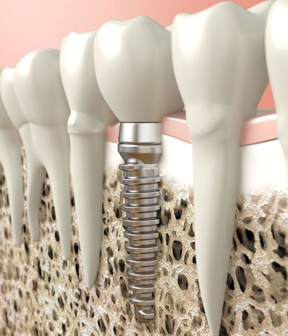 Illustration of an implant-supported crown