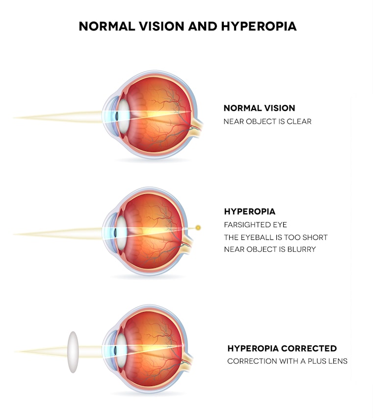 Graphic demonstrating difference in sight between a normal, hyperopic, and corrected eye.