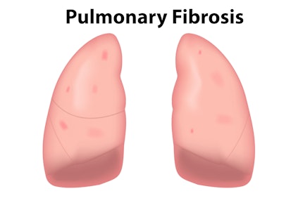 Illustration of lungs with pulmonary fibrosis