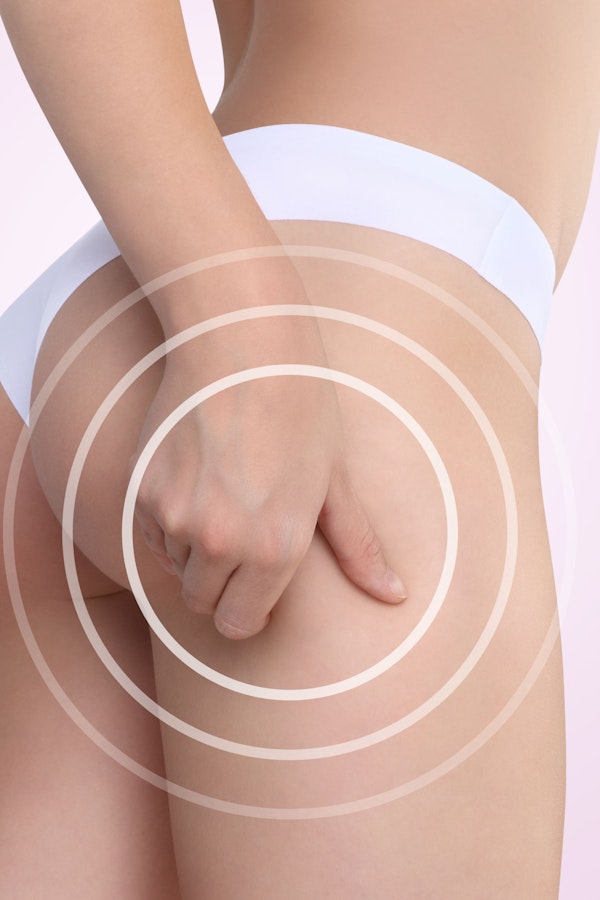 woman pinching back of thigh