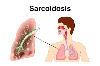 Illustration highlighting the effects of sarcoidosis
