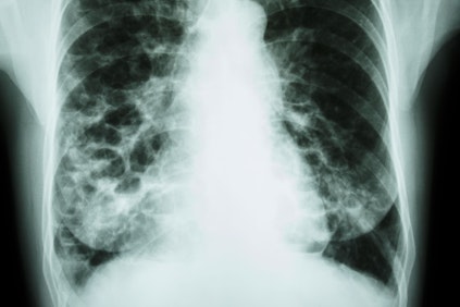 X-rays of lungs with mesothelioma