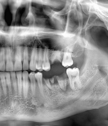 X-ray showing missing tooth