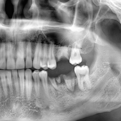 X-ray showing missing tooth