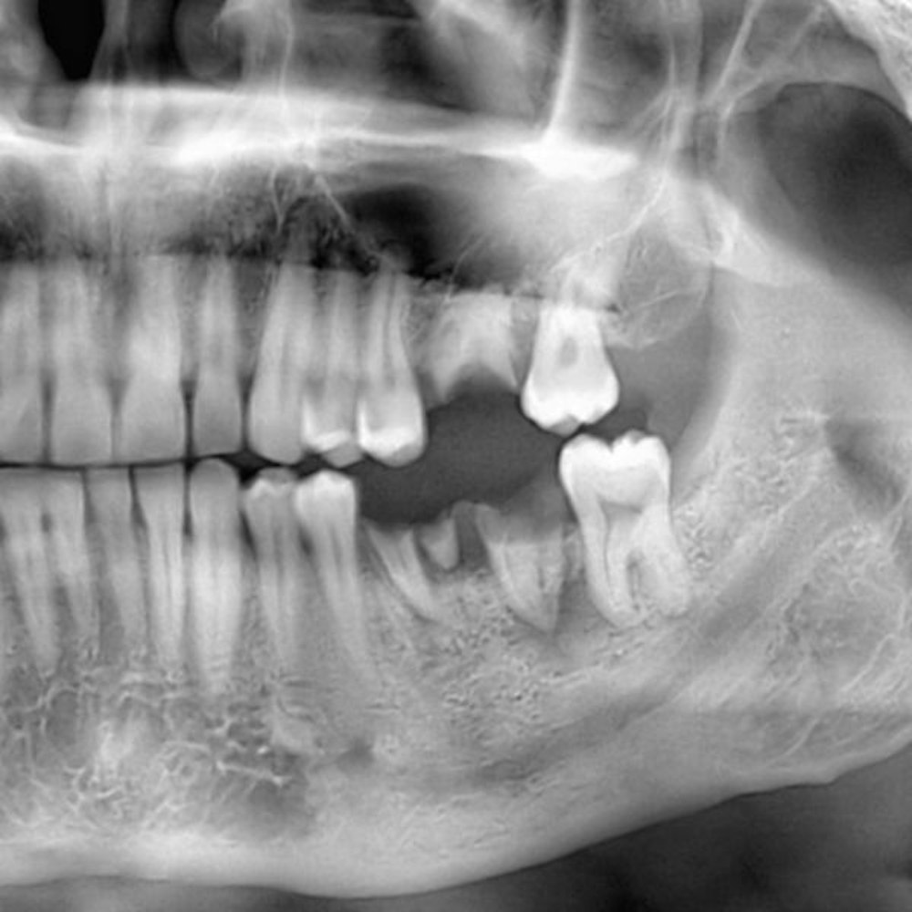 Dental X-ray