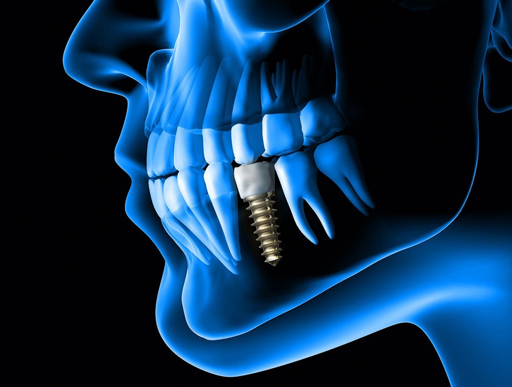 Dental Implant Placement xray