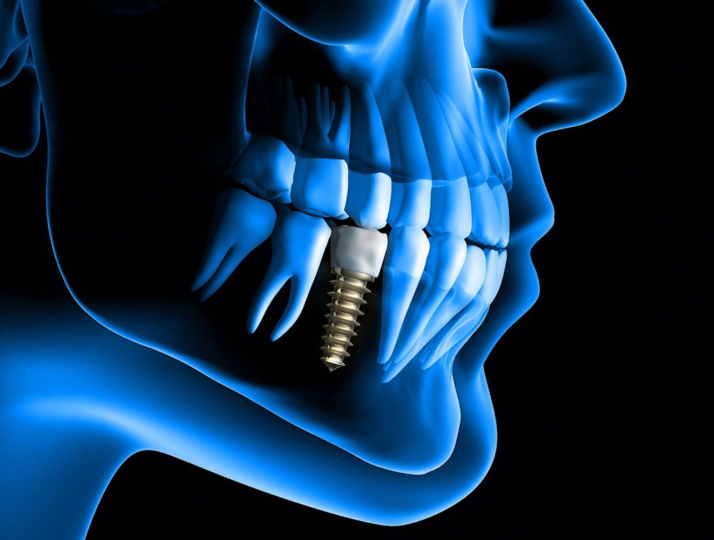 Dental implant x-ray