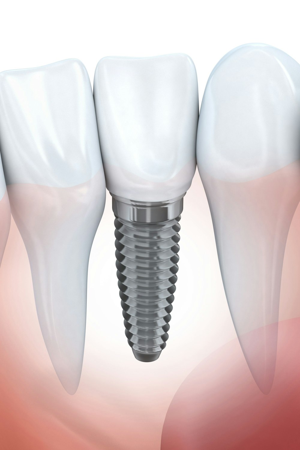 Illustration of a dental implants